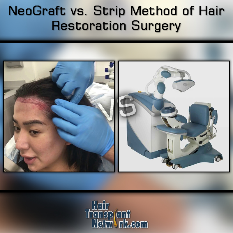 NeoGraft vs. Strip Method of Hair Restoration Surgery