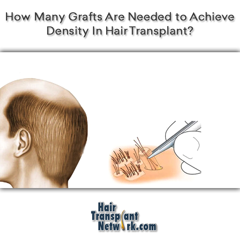 How Many Grafts Are Needed to Achieve Density In Hair Transplant